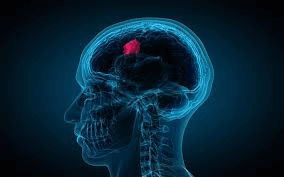 Brain tumor embolization procedure