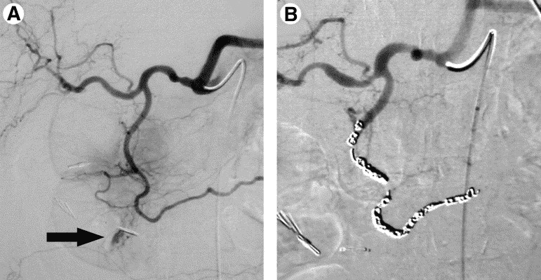 GI bleeding embolization procedure