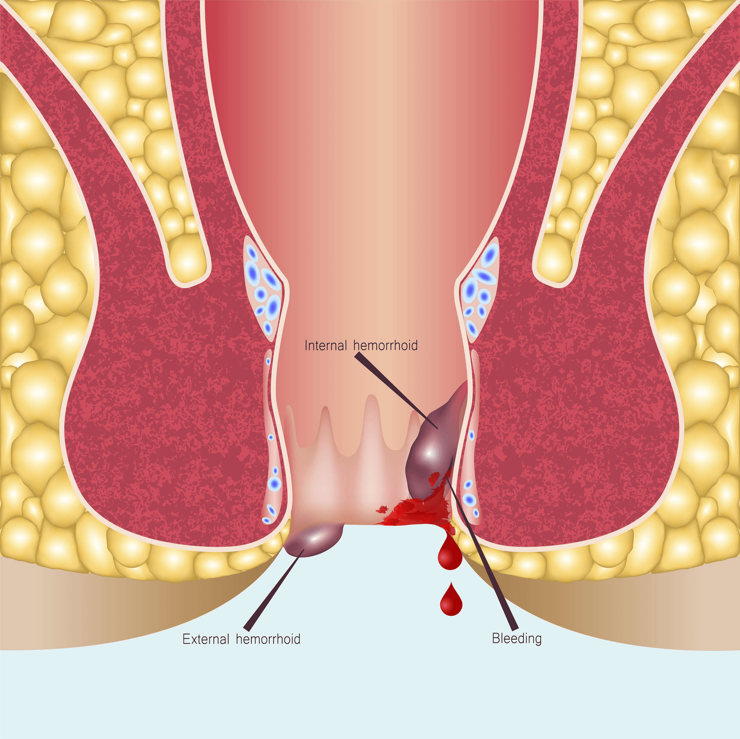 Hemorrhoid embolization procedure