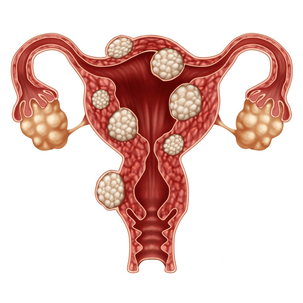 Uterine Fibroid Embolization procedure